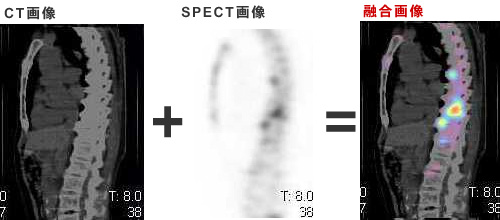 CT画像とSPECT画像を融合させることにより診断能がUP