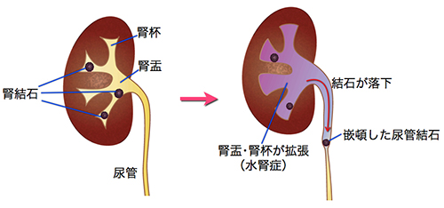 尿路結石の症状