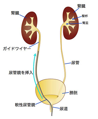 尿路結石の症状