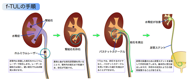f-TULの手順