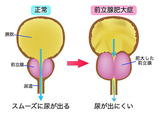 前立腺肥大症とは