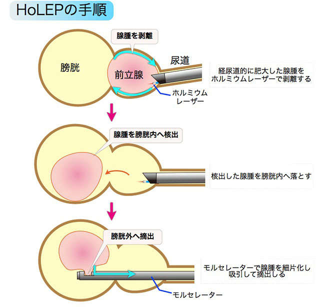 HoLEPの手順