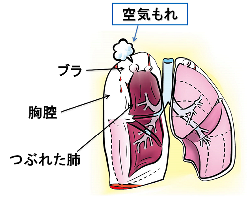 気胸とは