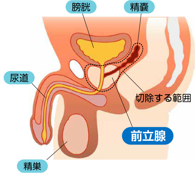前立腺の位置と手術の範囲