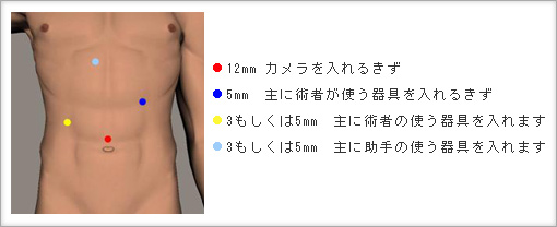 板橋中央総合病院 きずの小さな手術 腹腔鏡手術センター 当院で可能な