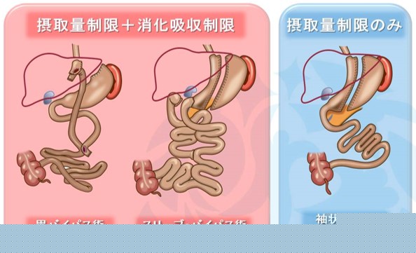 減量手術