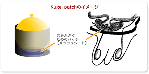 Kugel patchのイメージ