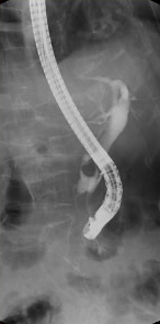 ERCP
